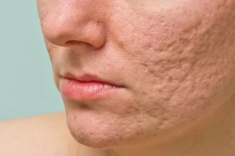 Waspada! Ini 7 Faktor Penyebab Munculnya Bekas Jerawat Yang Harus Diwaspadai
