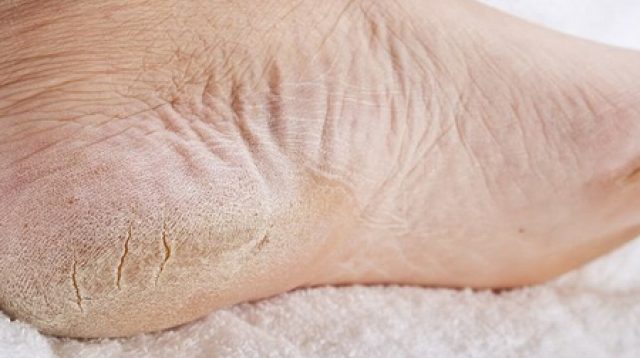 8 Cara Merawat Kulit Kaki Agar Tetap Halus dan Bebas Pecah-Pecah, Yakin Gamau Nyoba?