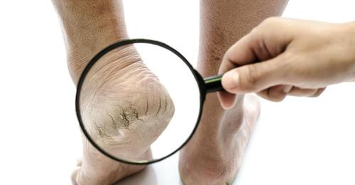 Jarang Disadari! Ini Pengaruh Cuaca Alam Terhadap Masalah Kaki Pecah-Pecah