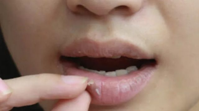 5 Rekomendasi Scrub Bibir Dengan Bahan Alami Untuk Mengatasi Bibir Kering