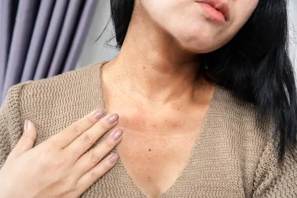 Micin dan Reaksi Alergi yang Ditimbulkannya, Berikut Fakta, Mitos, dan Tinjauan Ilmiah Menurut WHO