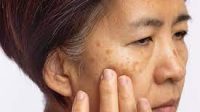 7 Cara Ampuh Menghilangkan Flek Hitam di Wajah Tanpa Efek Samping, Salah Satunya Gunakan Bahan Alami Ini