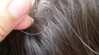 Benarkah Stres dapat Mempengaruhi Kesehatan Rambut Anda? Begini Ulasannya