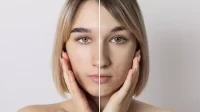 9 Tips Efektif untuk Merawat Kulit Belang pada Oily Skin, Pilih Produk dengan Kandungan Ini Salah Satunya