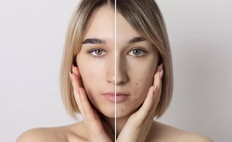9 Tips Efektif untuk Merawat Kulit Belang pada Oily Skin, Pilih Produk dengan Kandungan Ini Salah Satunya